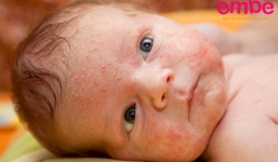 Những phương pháp trị rôm sảy cho bé hiệu quả nhất các mẹ nên biết