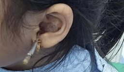 Bé gái 6 tuổi bị thanh kim loại đâm thẳng vào tai khi lấy ráy, cảnh báo sai lầm cực nguy hại