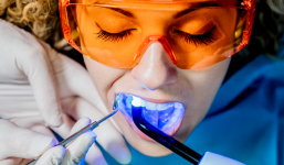 Công nghệ tẩy trắng răng hiện đại tại Nha Khoa Đăng Lưu