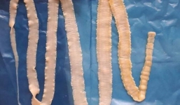 Bệnh sán lợn nguy hiểm như nào? Dấu hiệu nhận biết bị bệnh sán lợn