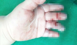 Nghệ An: Xót xa bé trai 16 tháng tuổi bị máy xay thịt nghiền nát bàn tay