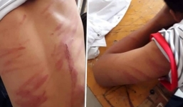 Có 79 vết thương trên cơ thể học sinh lớp 8 bị bố đánh dã man ở Hà Tĩnh