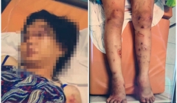 Nhóm người tra tấn thai phụ 18 tuổi: Dùng bình gas có đầu khò dí vào tay, chân