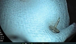 Bác sĩ giật mình khi chụp X-quang cho bé trai 11 tháng thấy chiếc đinh vít trong dạ dày