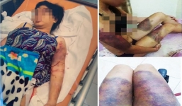 Nhóm người tra tấn thai phụ 18 tuổi vì nợ nần có thể đối diện khung hình phạt 12 năm tù