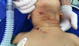 Đồng Nai: Bé trai 3 tuổi bị chó đẻ nhà hàng xóm cắn chảy máu cổ, chấn thương nặng