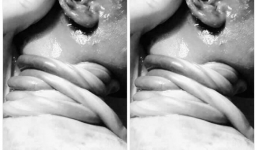 Hy hữu: Bé gái sinh thường dây rốn quấn cổ 5 vòng