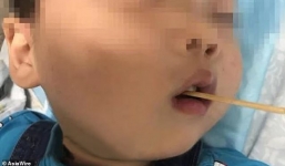 Hy hữu: Bé trai 3 tuổi sống sót thần kỳ sau khi bị xiên xúc xích đâm xuyên não