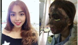 Cô gái bị chồng chưa cưới cuồng ghen tạt axit hủy hoại toàn bộ khuôn mặt