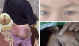 Bé gái 12 tuổi nghi trộm tiền bị công an viên đánh phải nhập viện