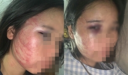 Cô gái trẻ mang thai 7 tháng cầu cứu cư dân mạng vì bị chồng bạo hành dã man