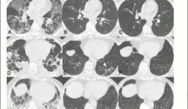 Hình ảnh CT phổi của người mắc Covid-19 (F0) sau 1 năm âm tính: Hệ quả kéo dài