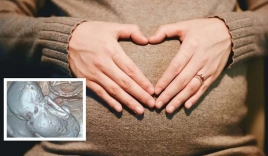 Cụ bà mang thai 35 năm không sinh, đi khám phát hiện 'em bé' 10.000 ca mới có một