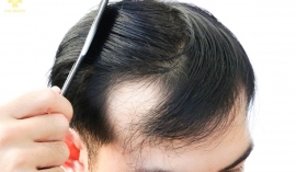 Điều trị hói chữ M cùng công nghệ cấy mầm tóc Max Hair tại AVA Beauty