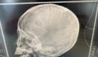 Vụ bé gái 3 tuổi bị đóng 9 chiếc đinh vào đầu: Bàn giao nghi phạm cho Công an TP Hà Nội 