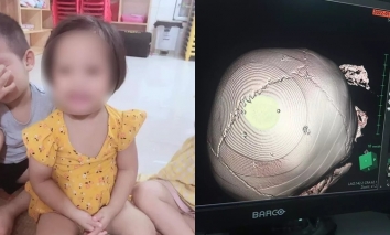 Vụ bé 3 tuổi bị bắn 9 cái đinh vào não: Mẹ bé đang mang thai, quyết tâm đi theo nhân tình