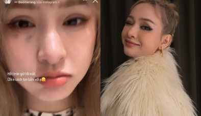 Hiền Hồ gây chú ý với vết bầm lớn trên mặt, netizen thở dài ngao ngán