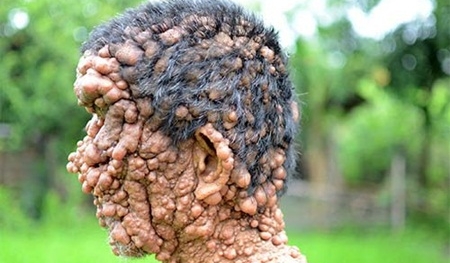 Cận cảnh người đàn ông 'mặt quỷ' ở Indonesia