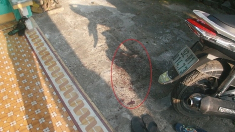 Nổ súng bắn xuyên gò má người yêu rồi chở đi cấp cứu