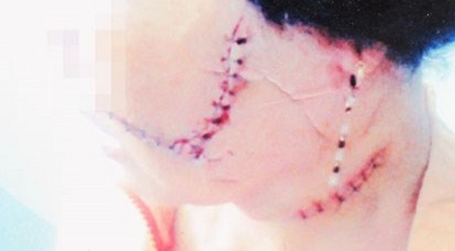 Bị rạch mặt, đòi 90 triệu đồng chi phí phẫu thuật thẩm mỹ