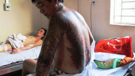 Bị tạt axit, người đàn ông ngã khụy giữa đường