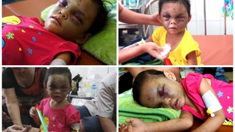 Tạm giữ hình sự cặp vợ chồng đánh bé gái 4 tuổi chấn thương sọ não