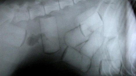 Bố bắt con gái 11 tuổi nuốt 0,5 kg ma túy vào bụng