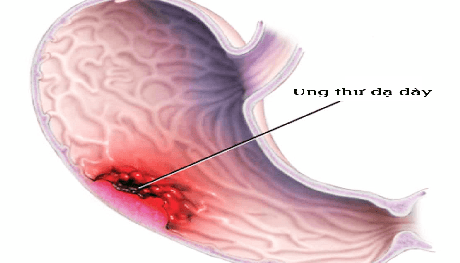 Căn bệnh đáng sợ khiến bệnh nhân không sống được 5 năm