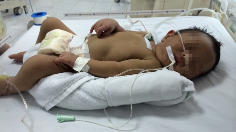 Bé sơ sinh phải cắt bỏ gần 2m ruột bị hoại tử