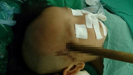 Bé gái 3 tuổi bị dao xuyên thấu vào đầu