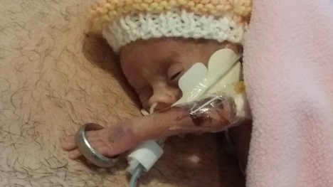 Bé sinh non có bàn tay lọt thỏm trong nhẫn cưới