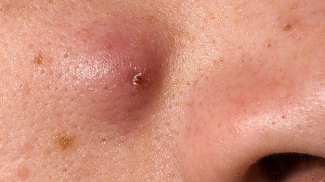 Nhiễm trùng máu và tử vong do tự nặn mụn