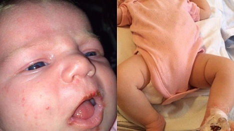 Bé sơ sinh suýt từ vong vì...được hôn