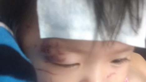 Bé gái 11 tháng tuổi bị nhiều vết thương trên mặt khi đi nhà trẻ