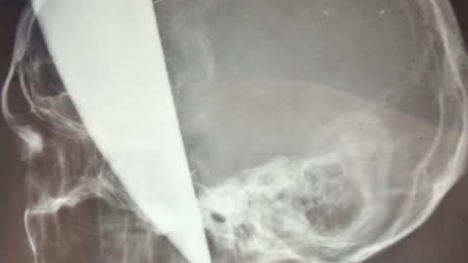 Cứu nam thanh niên bị dao bầu đâm xuyên não