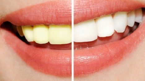 Giải đáp thắc mắc: Làm trắng răng có hại không?