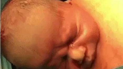 Video: Em bé tự bật ra khỏi bụng mẹ trong ca sinh mổ tự nhiên