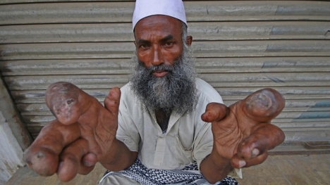 Người đàn ông có' đôi bàn tay kì quái', nhưng luôn hy vọng điều kỳ diệu xảy đến