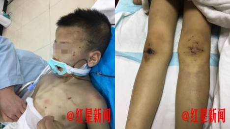 Đến thăm con, mẹ chết lặng khi phát hiện con trai bị vợ hai của chồng đánh đập thậm tệ