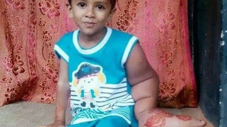 Xót ca cậu bé bị cả làng xa lánh vì có 'bàn tay voi'