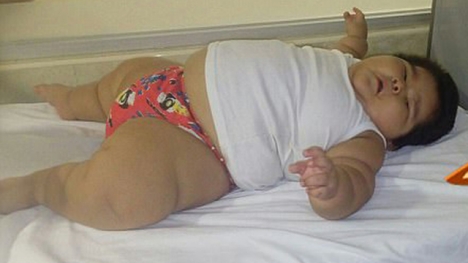 Mắc hội chứng lạ khiến bé trai 10 tháng mang cân nặng của trẻ 9 tuổi, không thể ngủ vì quá béo