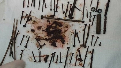 Cụ bà U80 sợ thiếu máu, nuốt 152 đinh vít để bổ sung sắt