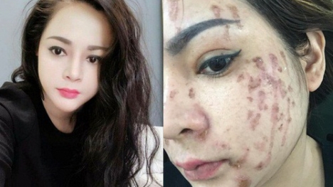 Nghe lời nhân viên spa chấm nám cho đẹp da, cô gái trẻ bị thui cháy loang lổ cả mặt