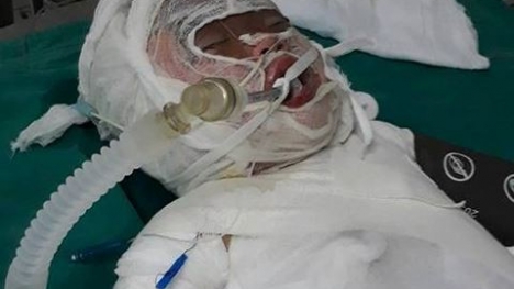 Theo mẹ ra đồng muối, bé gái 2 tuổi bị bỏng nặng khi rơi vào hố vôi đang sôi