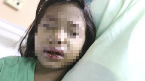 Đến đón con ở nhà chồng cũ, mẹ đau đớn phát hiện con bị mẹ kế bạo hành ép uống nước sôi