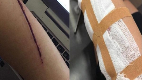 Xôn xao hình ảnh cô gái bị rạch tay cướp tài sản ở Hà Nội