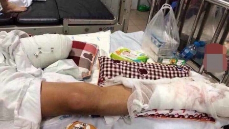 Thêm tình tiết kinh hoàng vụ thanh niên bị truy sát chém nát chân