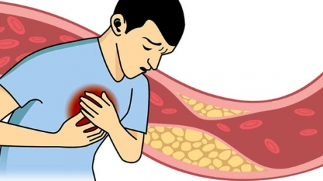 Nattokinase Jintan Nhật Bản – giải pháp mới cho người mỡ máu cao, phòng bệnh tai biến và tim mạch