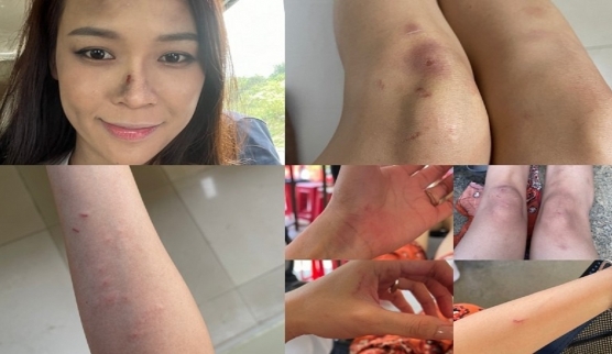 Hot girl Sam gặp vấn đề sức khỏe đáng báo động khi liều mình vì vai diễn