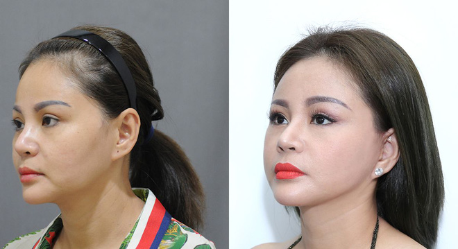 Danh hài Lê Giang không ngại thừa nhận chuyện mình thẩm mỹ. Ảnh internet